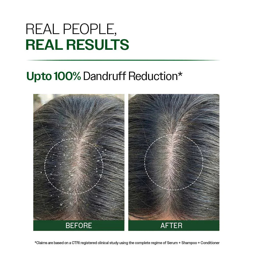 Hair Growth Serum (30 ml) & Anti-Dandruff Shampoo (250 ml) Combo